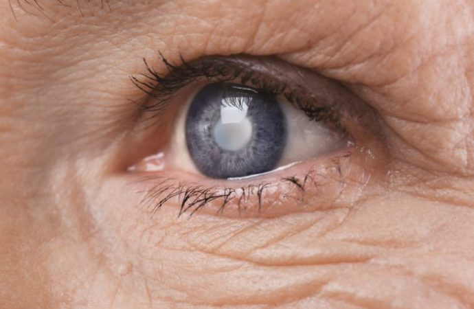 Glaucoma - Oftalmocentro Uberaba